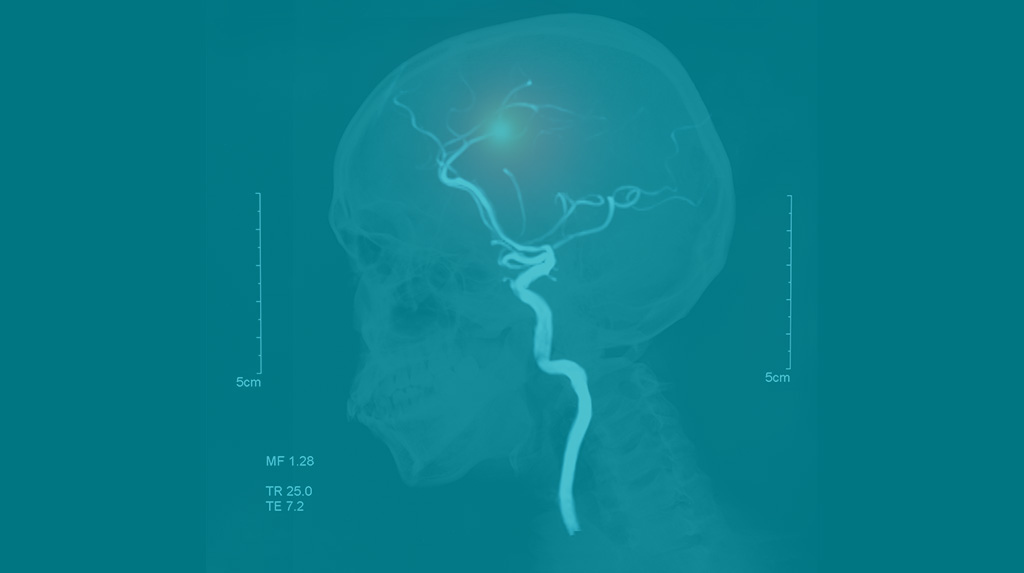 Neurovascular catheter gets re-engineered to boost trackability—in only 3 weeks 
